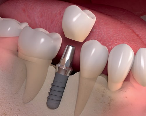 Dental Implant 2 | Coast Family Dental Currimundi