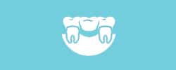 Dental bridges | Coast Family Dental Currimundi