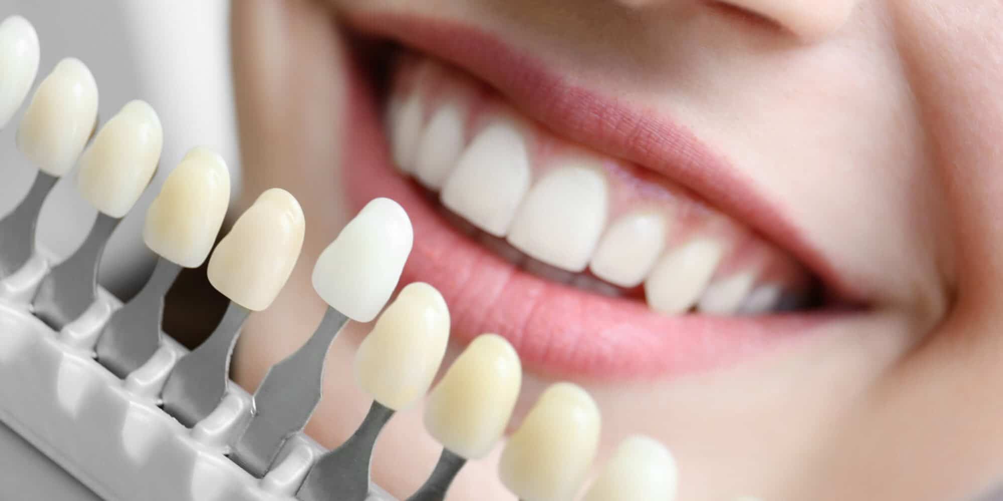 Teeth Whitening 5 | Coast Family Dental Currimundi