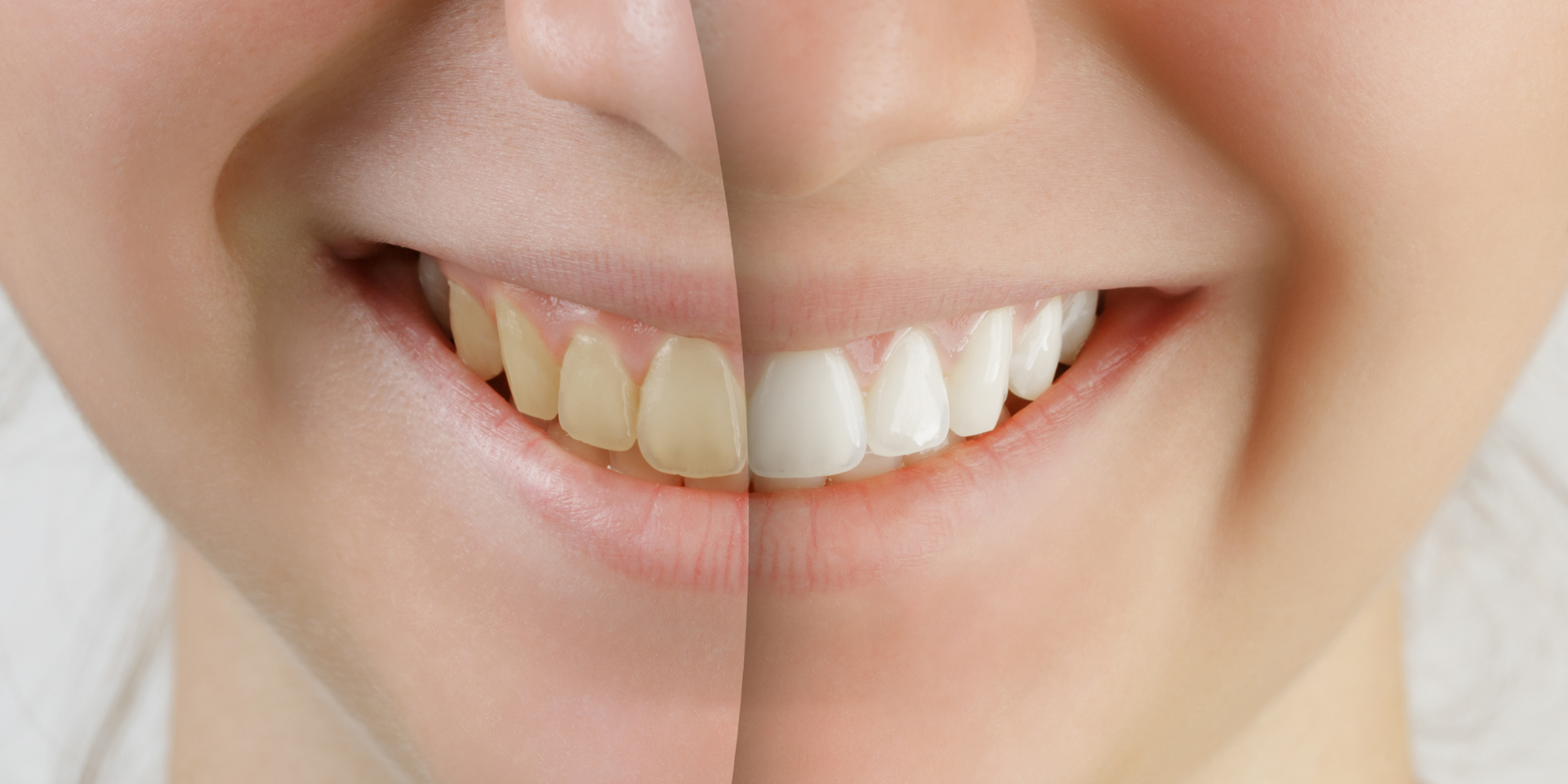 Teeth Whitening Coast Family Dental