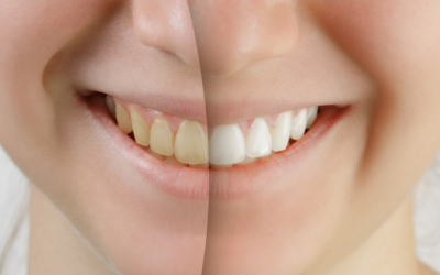 Teeth Whitening