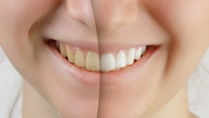 Teeth Whitening Coast Family Dental