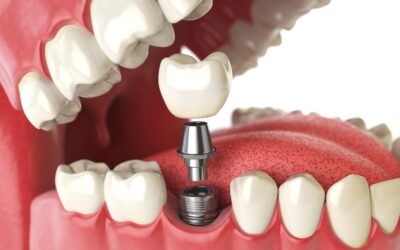 Dental Implants and the Importance of Replacing Teeth