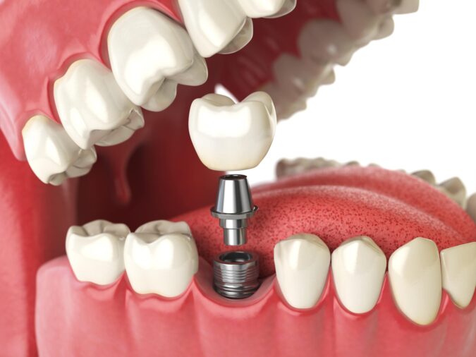 Dental Implants CF Image-minimum Coast Family Dental