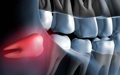 Wisdom Teeth – What Are They & Why Might They Need To Be Removed?