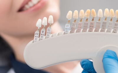 Porcelain Veneers vs Composite Veneers