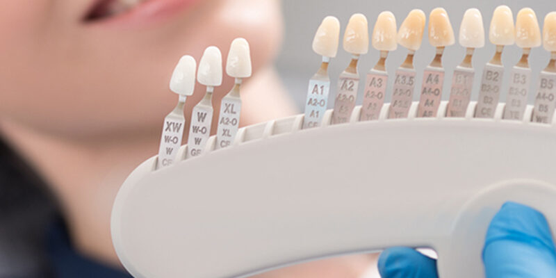 Veneers-img Coast Family Dental