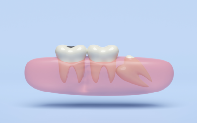 What To Expect When Getting Your Wisdom Tooth Removed