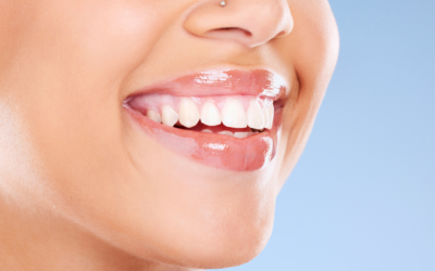 Teeth Whitening in the Sunshine Coast: Is It Worth It?