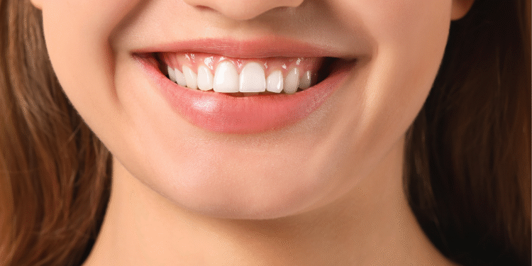 gum-disease-treatment-cf-dental