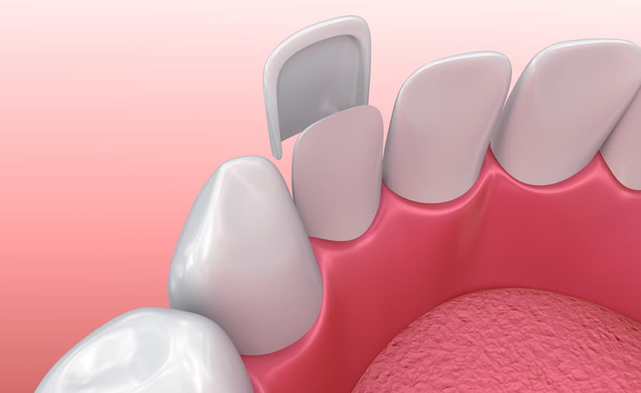 dental crowns and veneers at coast family dental in currimundi